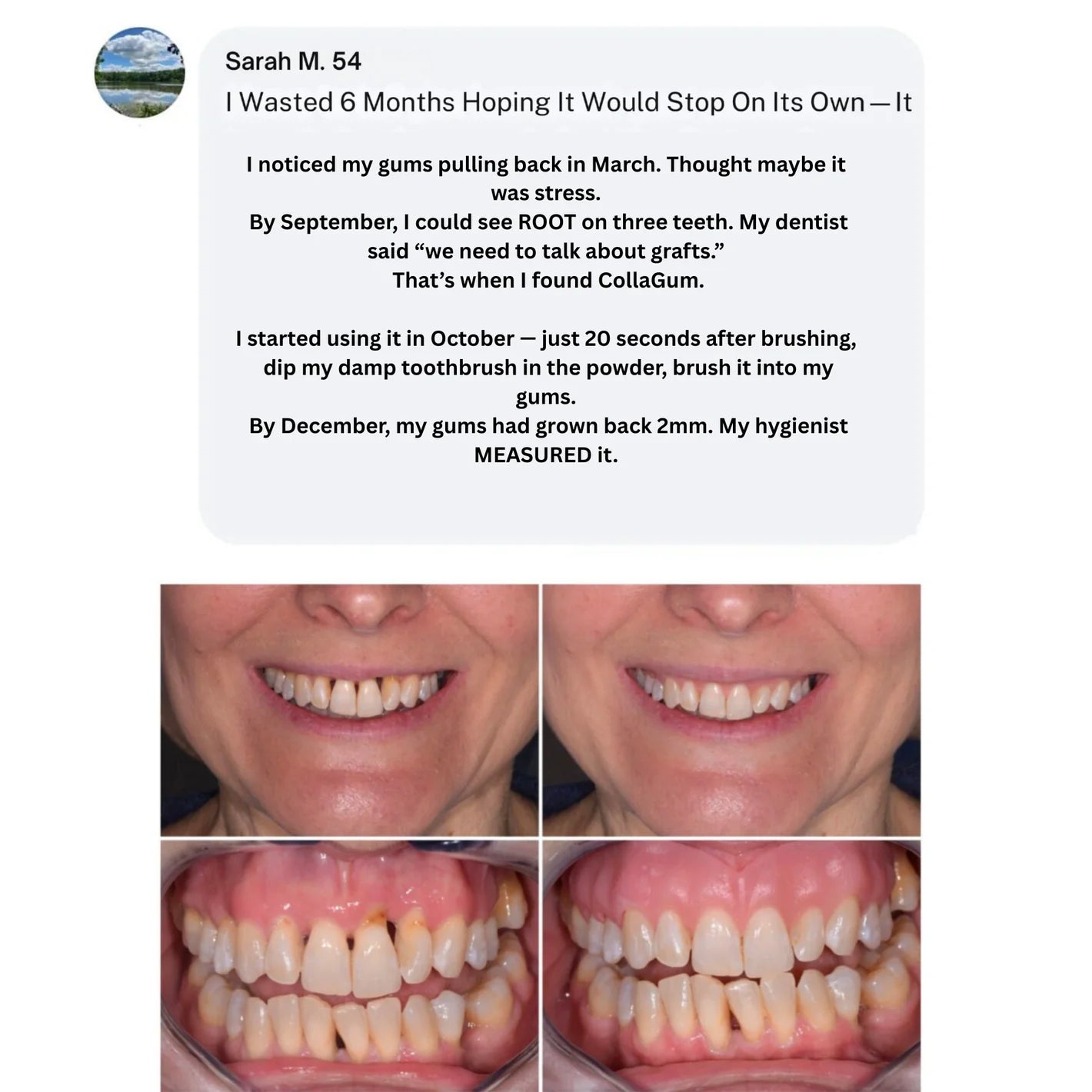 CURO™ CollaGum™ Strengthens gums & enamel